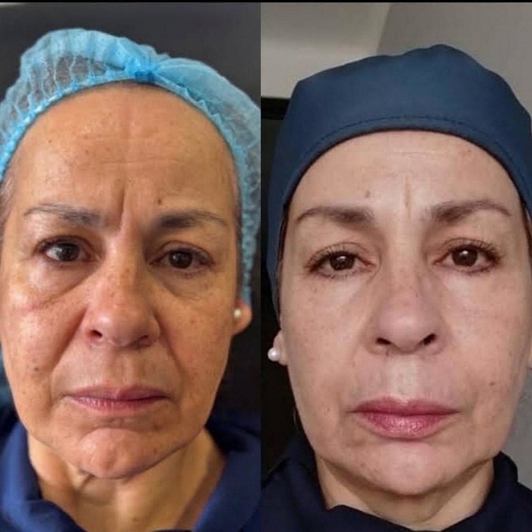 Antes y después de Endolifting: rostro completo