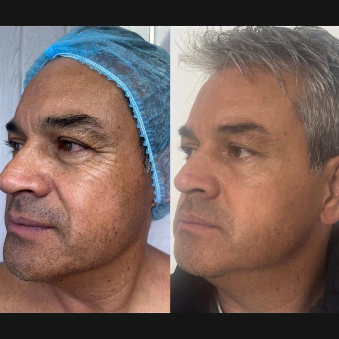 Antes y después de Endolifting en hombre: óvalo facial y líneas de expresión