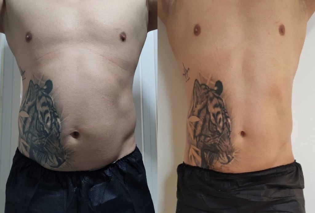 Antes y después de tratamiento corporal: abdomen masculino