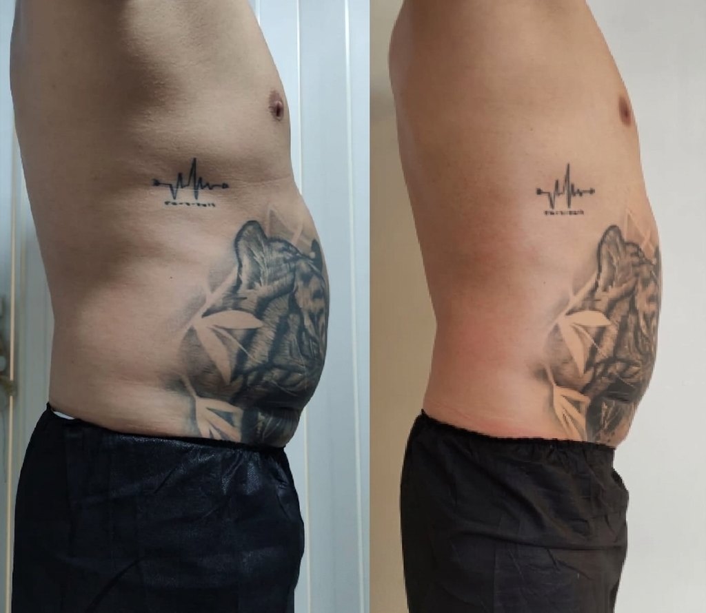 Antes y después de tratamiento corporal: perfil masculino