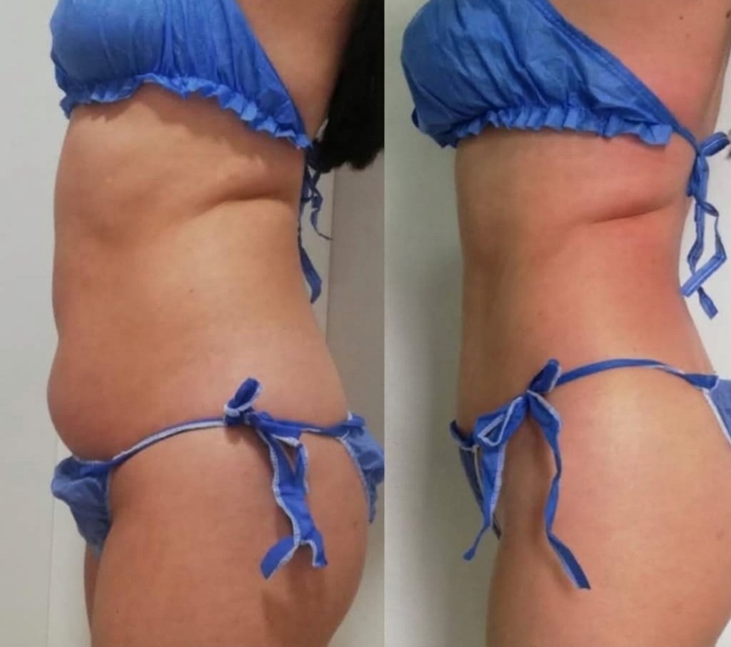 Antes y después de tratamiento corporal: perfil de abdomen