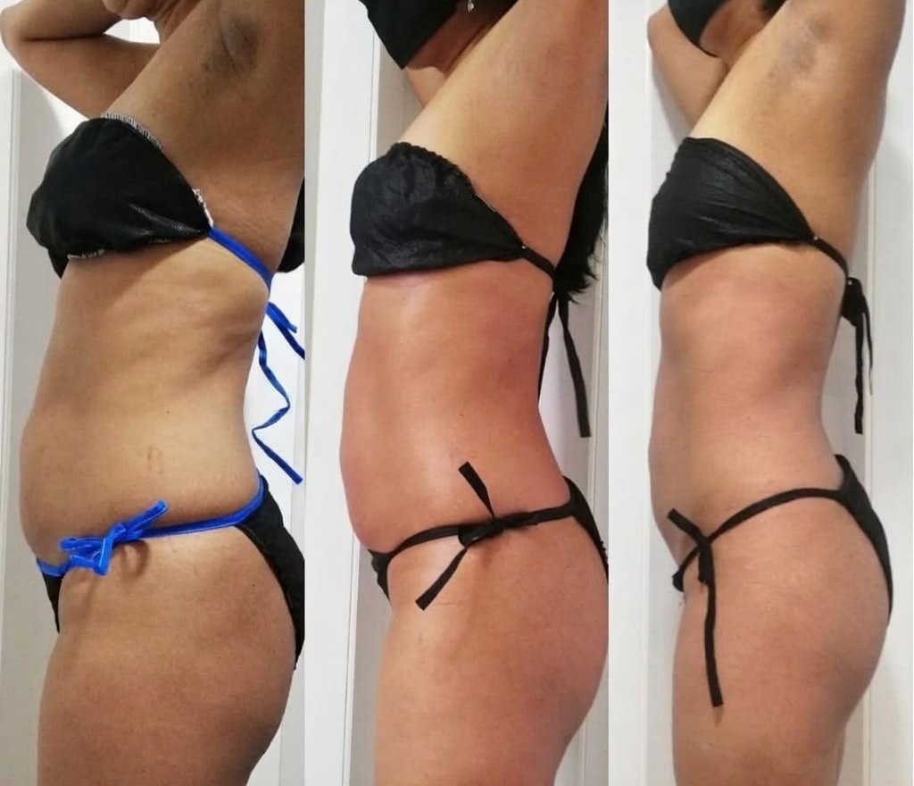 Antes y después de tratamiento corporal: cintura de perfil
