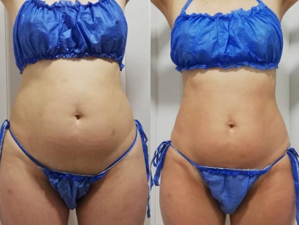 Antes y después de tratamiento corporal: abdomen
