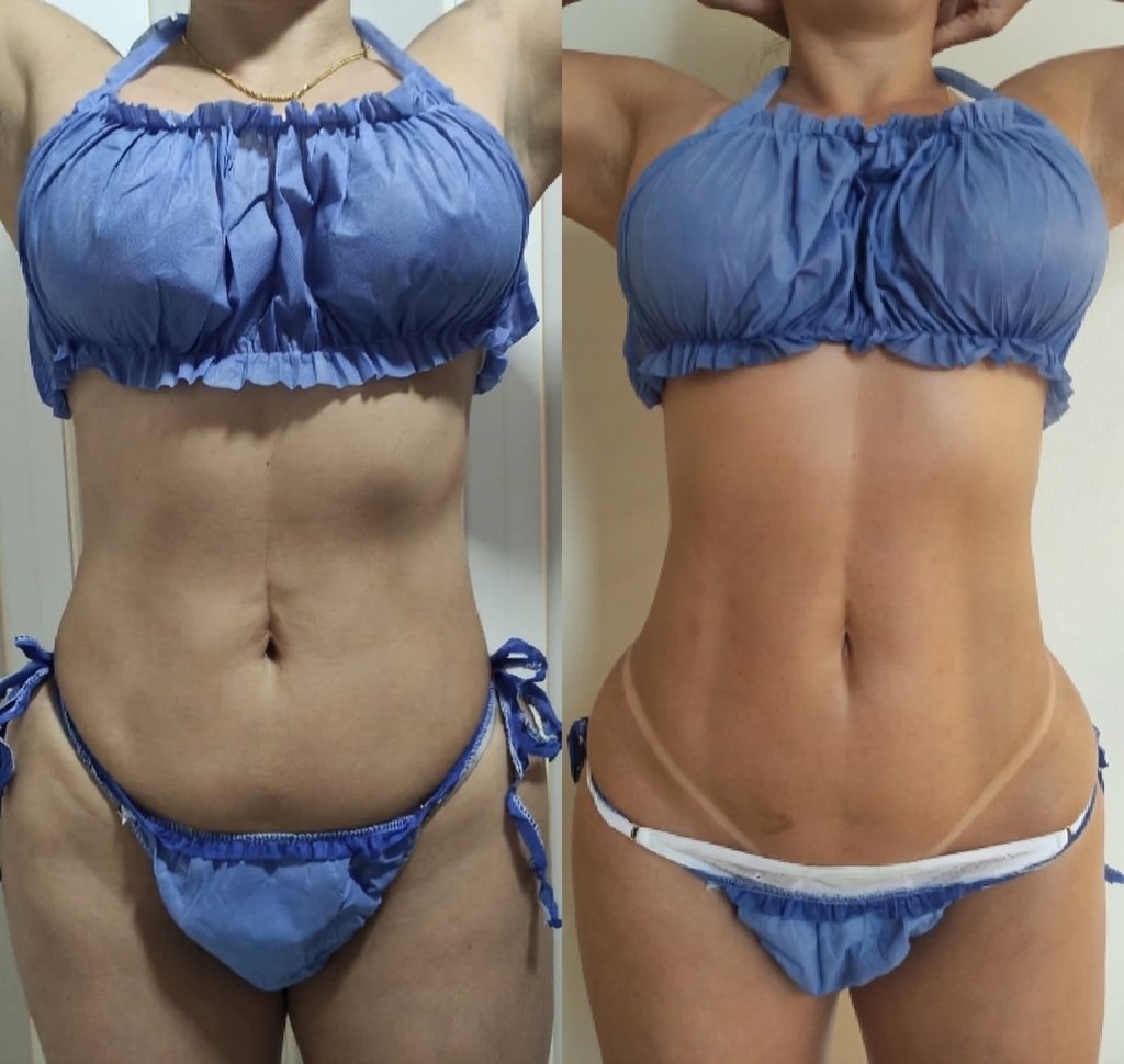 Antes y después de tratamiento corporal: abdomen y cintura